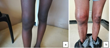 Clinical pictures of swollen, warm, red, painful joints