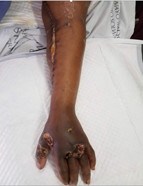 Clinical picture of a forearm with multiple gunshot injuries and fasciotomy incisions. The dusky hand indicates compromised perfusion.