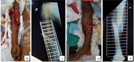 Clinical and radiological images of open fractures
