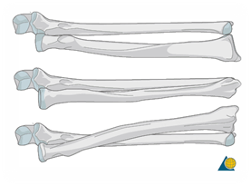 Pronation of the forearm, showing the rotation of the radius over the ulna (Source: AO Surgery)