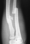 Both bone forearm fracture