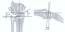 Normal anatomical measurements used to judge whether or not a reduction is acceptable