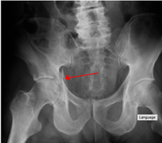 X-Ray: Right acetabular fracture. Notice the disruption through the socket of the right hip.