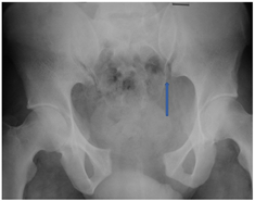 X-Ray image of an ‘open book’ pelvic injury. Note the wide separation of the pubic symphysis and the widening of the left sacroiliac joint compared to the right.