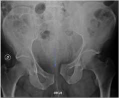 X-ray image: pelvis vertical shear-type injury. Notice the cephalad migration of the left hemipelvis associated with left sacral alae fracture.