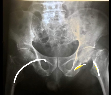 X-ray pelvis (AP): Left hip fracture with disruption of the Shenton’s line (yellow)