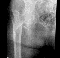 AP right hip: Peritrochanteric fracture with an intact femur neck.