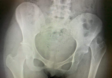AP X-ray pelvis: Left hip dislocation. The Shenton’s line is disrupted. The hip is internally rotated (lesser trochanter is not visible), and the femoral head appears smaller than the contralateral side (closer to the X-ray film).