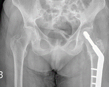 AP pelvic X-rays: Total hip replacement (above) and dynamic hip screw (below).