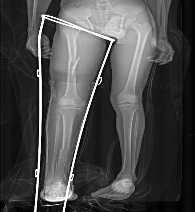 long bone fracture