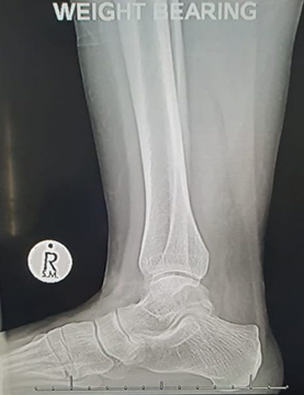Normal lateral ankle X-ray