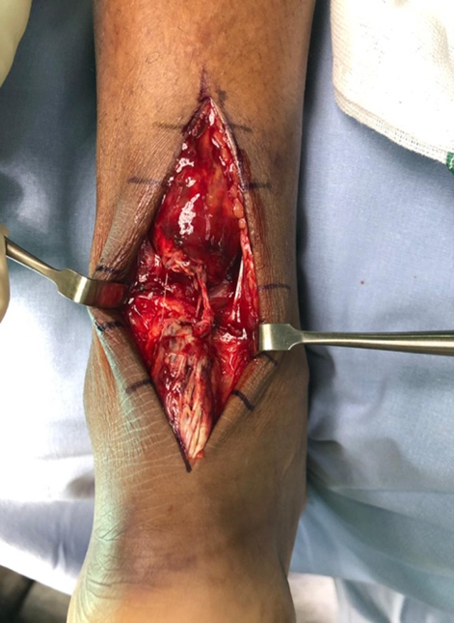 Intraoperative view of the Achilles’ tendon gap following closed rupture