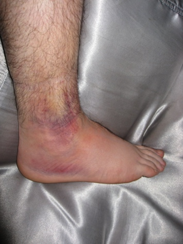 Ecchymosis and swelling associated with a lateral ligament injury