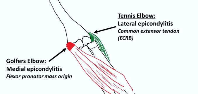 The flexor-pronator mass origin is affected in golfer’s elbow, and the common extensor tendon is affected in tennis elbow