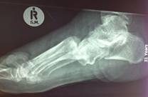 Lisfranc injury with dorsal displacement of the metatarsal bones