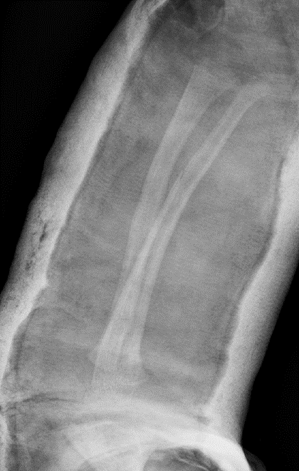 Post-reduction X-rays