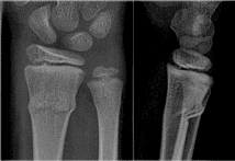 Buckle fracture of the distal radius