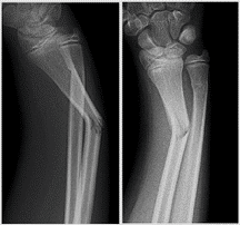 Greenstick fracture of the radius with an associated buckle fracture of the distal ulna 