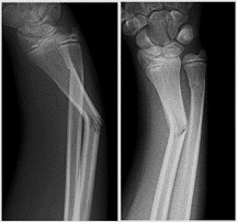 buckle fracture ulna