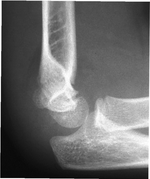 Grade 1 supracondylar fracture evidenced by the presence of a posterior fat pad. It is undisplaced as the anterior humeral line passes through the capitellum.
