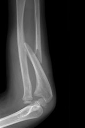 Angulated and shortened ulna fracture with intact radius and radial head dislocation