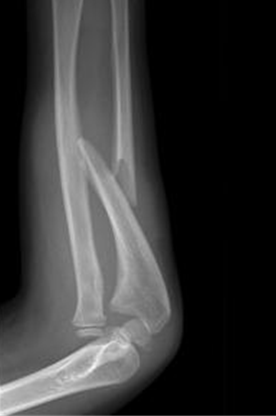 ulna fracture x ray