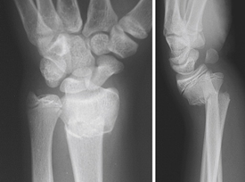 Displaced distal radius fracture with volar dislocation of the distal ulna