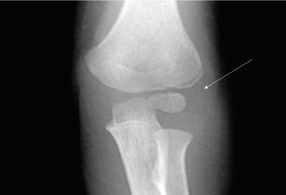 Minimally displaced lateral condyle fracture