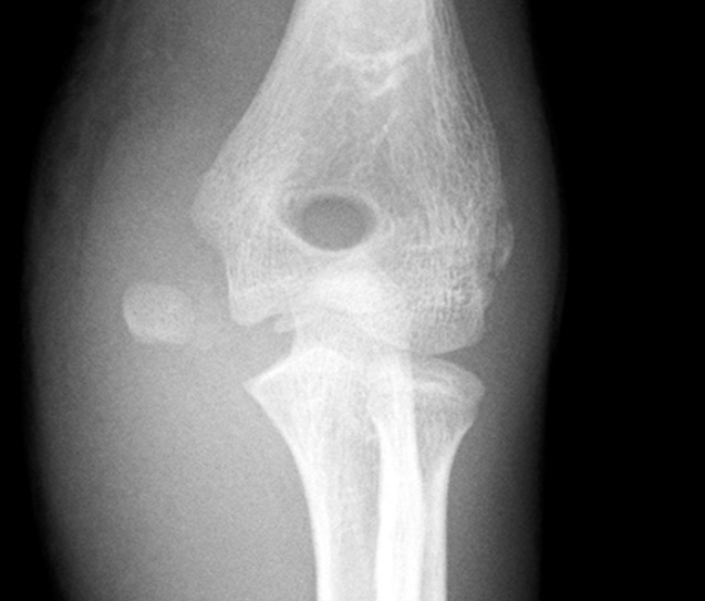 Medial epicondyle avulsion following elbow dislocation