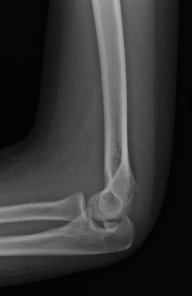 Medial epicondyle incarcerated in joint