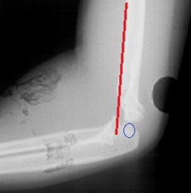 Lateral X-ray of Type 2 supracondylar fracture with the anterior humeral line not crossing the capitellum