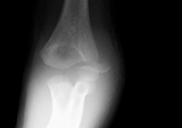 Widely displaced lateral condyle fracture
