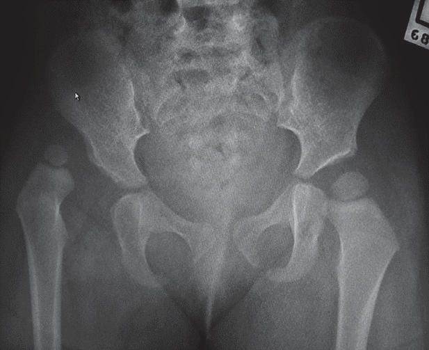 Right hip dislocation