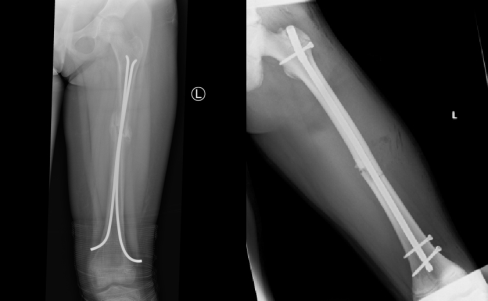 X-rays of (A) Retrograde IM nail and (B) Prograde IM nail