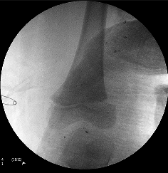 Salter Harris type I fracture of distal femur