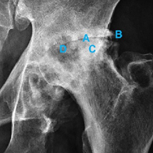 Osteoarthritis of the left hip A) joint space narrowing; B) osetophytes; C) subchondral sclerosis and D) subchondral cysts