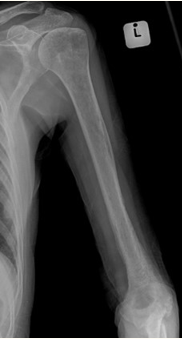 Radiograph of osteomyelitis in the distal humerus with a periosteal reaction