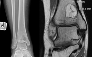 Radiograph and coronal MRI image of a Brodie’s abscess in the distal tibia