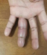 Fusiform swelling of ring finger