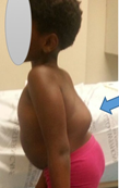 A four-year-old child with a thoracolumbar gibbus due to kyphotic collapse of the spine