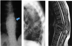 Typical X-ray features of sTB with paraspinal abscess shadow on the AP X-ray (left) and vertebral body collapse on the lateral X-ray (middle) and MRI (right).