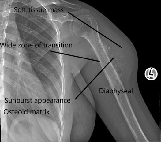 Anterior-Posterior (AP) X-ray of the patient’s left upper arm and shoulder showing a diffuse lytic lesion in its shaft/ diaphysis extending in a centrifugal (in all directions) manner.