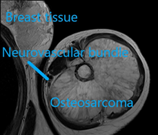 A MRI showing an axial image of the above patient’s mass. 