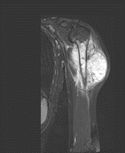 A MRI image showing a coronal view of the patient’s tumour. 