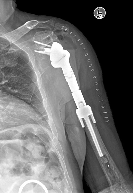 Post-operative X-ray showing wide resection of the tumour.