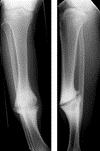 Non-union of a tibial fracture