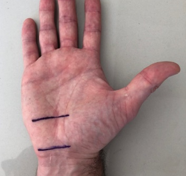 Location of the carpal tunnel