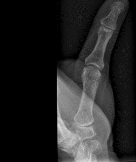 X-ray showing subluxation, joint space narrowing, sclerosis and osteophytes, with a Robert’s view on the right