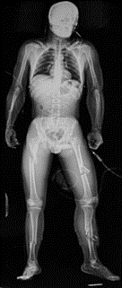 Patient with bilateral femur and tibia fractures, a potential cause of major blood loss