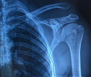 X-ray shows an acromioclavicular dislocation with more than 100% displacement.